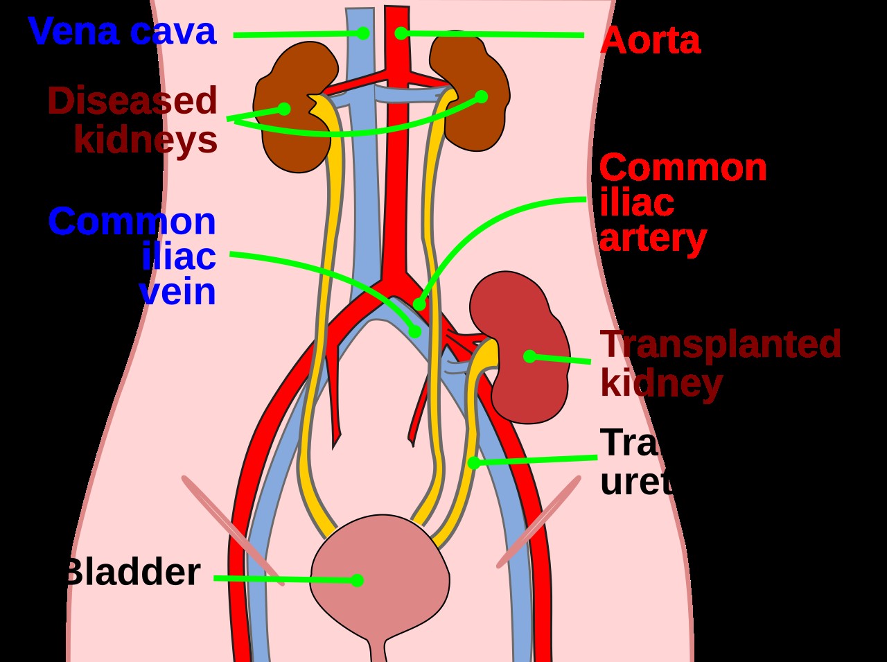 A labeled medical diagram of a kidney transplant, the diseased kidneys left in place and a donor kidney connected in the pelvis.